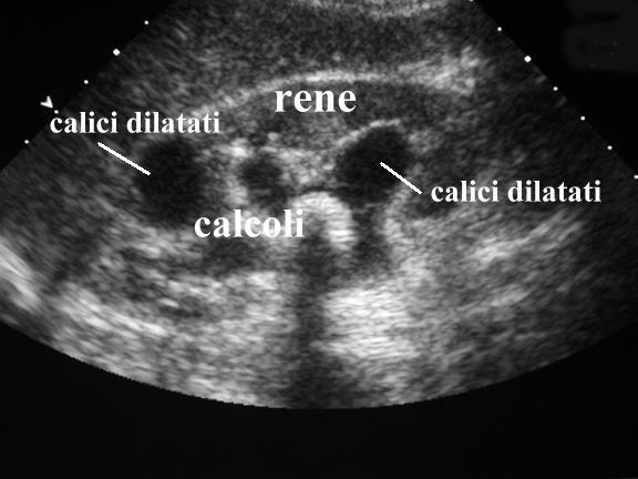 Espulsione Tipi Di Calcoli Renali Immagini CALCOLOSI DELL